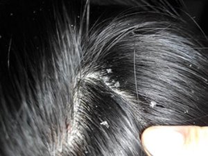 ͷƤ������ô�� ȥͷмͷ����Сƫ�� ����˵������Ч