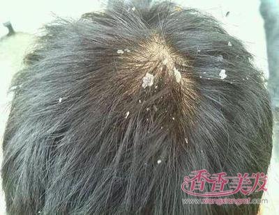 ͷм�ܴ����ʲôԭ�� ȥ��ͷм����Ч�ķ�����Ҳ������ͷɱ